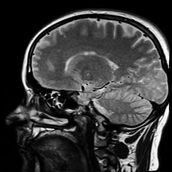 brain