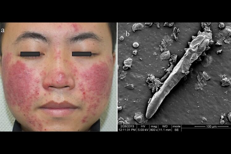 Demodex