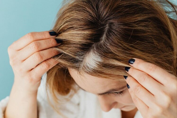 Woman showing hair loss.
