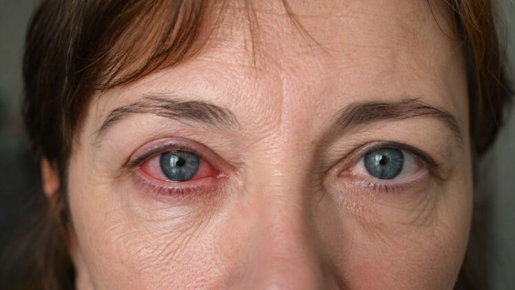 A woman's sore red eye.