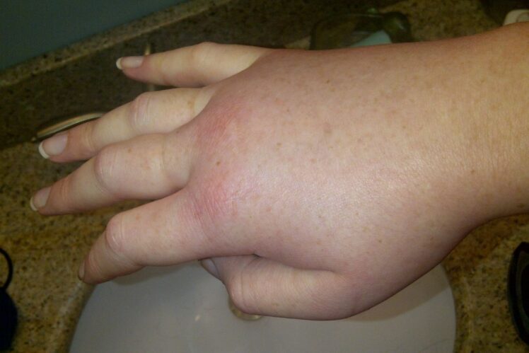 Swollen right hand in a female patient during a hereditary angioedema attack.
