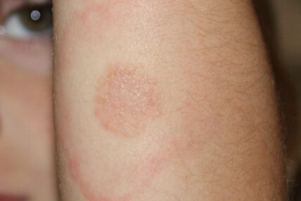 Lyme Disease type Rash on 5 year olds arm. Includes ringworm rash in the center