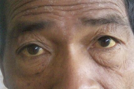 Man with yellow eyes.