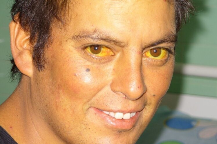 Patient with yellow eyes and yellow skin.
