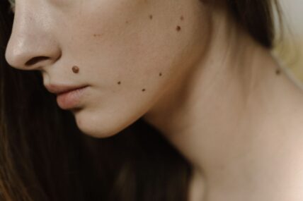 A woman with some moles on her face.