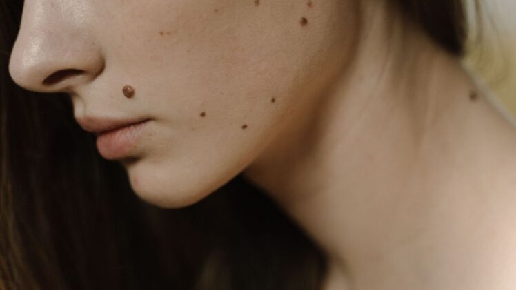 A woman with some moles on her face.